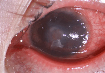 患流感5天不摘隐形近乎融化 医生：永久性视力损伤